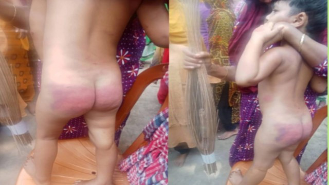 কিশোরগঞ্জের কটিয়াদীতে সৎ মায়ের নির্মম নির্যাতনের শিকার ৩ বছরের শিশু সোহা মনি